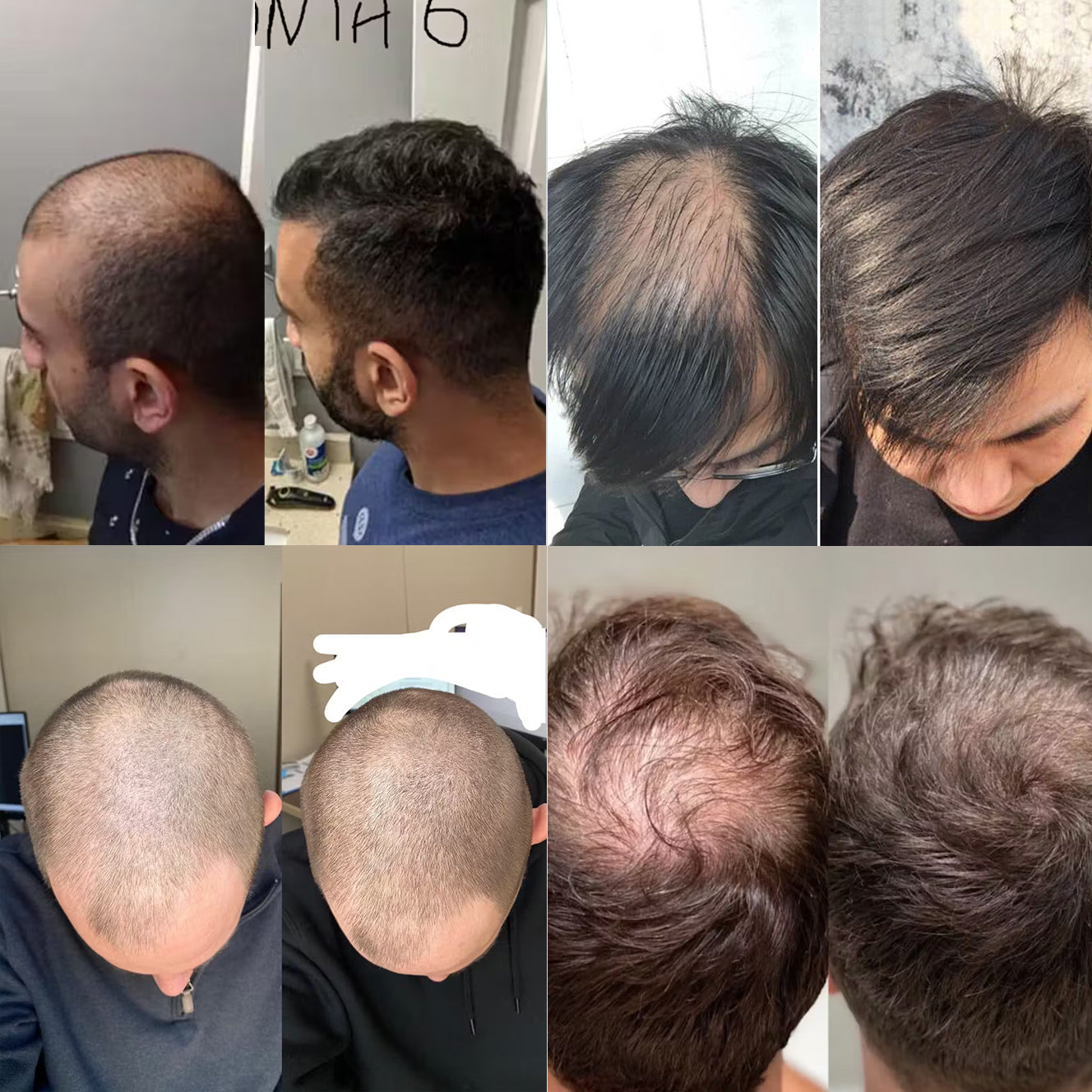 NESLEMY™ Hair Regrowth System