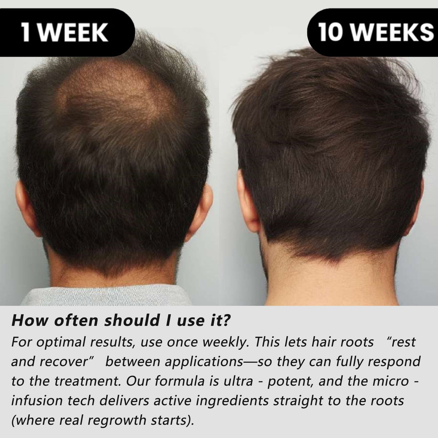 NESLEMY™ Hair Regrowth System